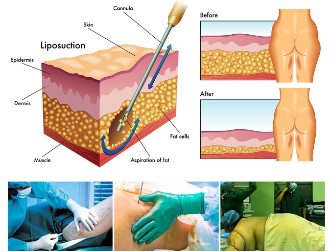 980nm 1470nm Липосакционная машина Удаление жира Лазерное оборудование липолиза