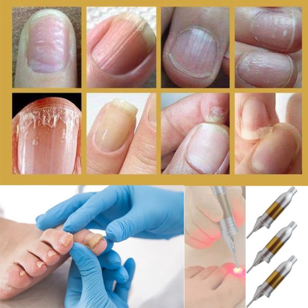 Машина лазера диода утверждения 980nm CE для терапии Onychomycosis ногтя грибной