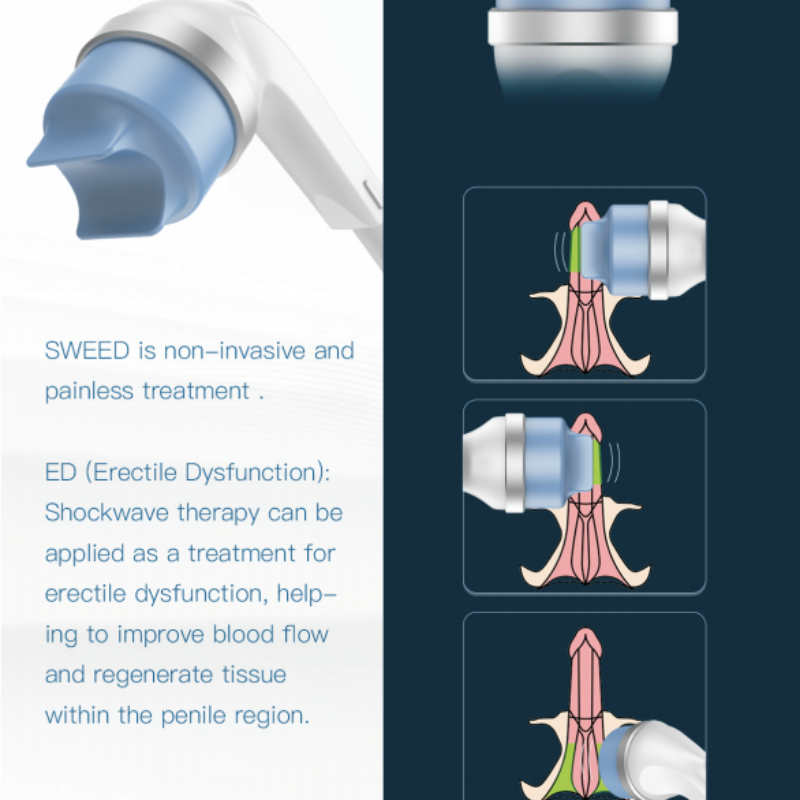 SW7 3rd Generation Electromagneto Focused Shockwave Therapy System for Physiotherapy and ED Treatment