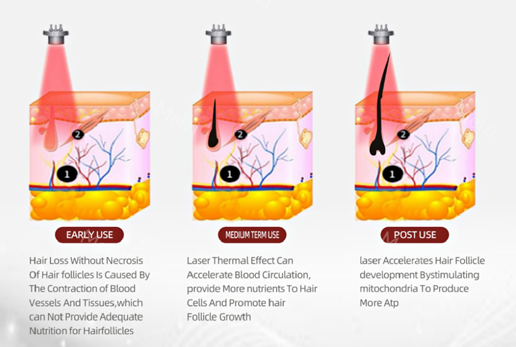 Рост волос/луковица волоса Pdt привели красоту лазера диода машины терапией вертикальную