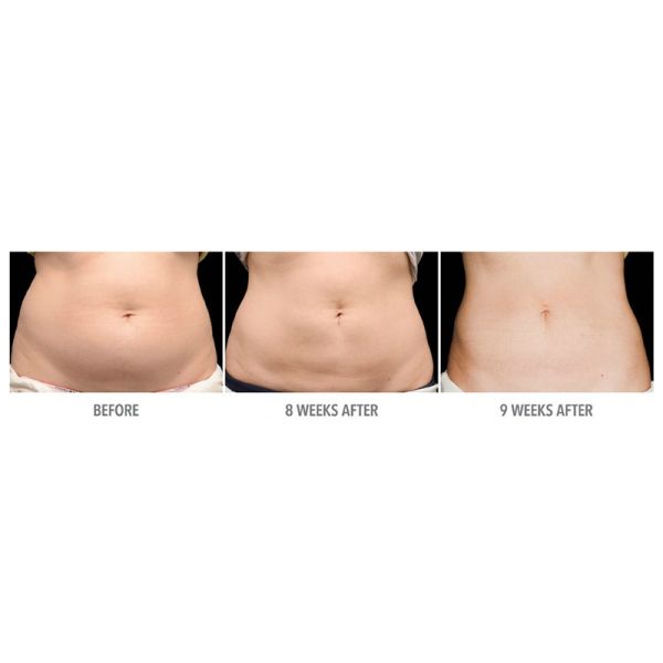 Машина Cryolipolysis компактного размера жирная замерзая отсутствие хирургического взреза