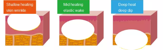 Устройства для красоты с радиочастотой