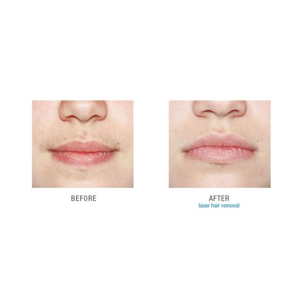 Portable Professional Ipl Hair Removal Machine , Ipl Machine For Skin Rejuvenation