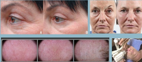8.4'' Color Screen RF Fractional Laser Equipment For Skin Rejuvenation / Vaginal Tightening
