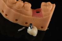 Precision Cylindrical Silver Single Tooth Replacement Implants Dental Restoration