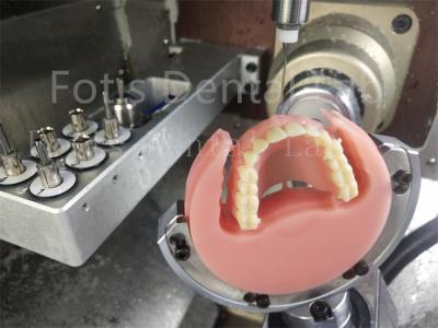 Ivoclar Natural Color Full Acrylic Denture Comfort Fit Prosthesis With Esthetics