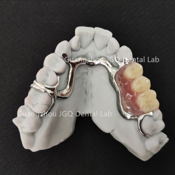 Lightweight Dental Framework Partial Dentures 3D Laser Printing Comfortable