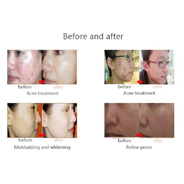 Facial PDT 7 Color LED Phototherapy Machine 5 Handles Acne Scar Treatment Machine