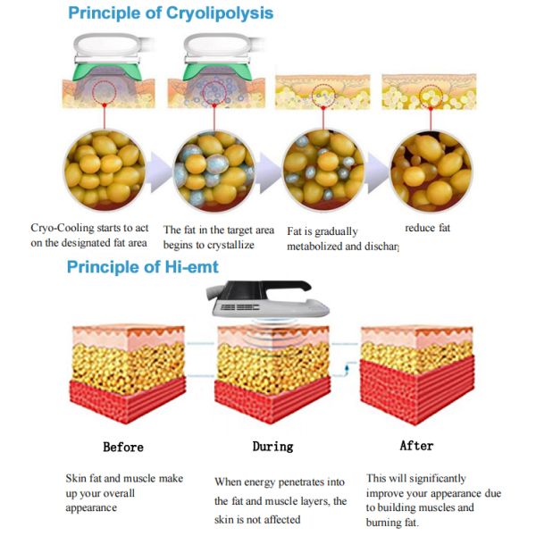 Тело техника Cryotherapy уменьшая машину для уменьшения жировой клетки липосакции