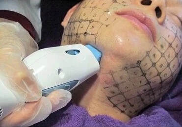 Portable Thermage 40.68Mhz Hifu Beauty Machine