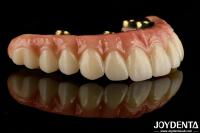 Puente híbrido de zirconia de barra de Ti para prótesis dentales duraderas