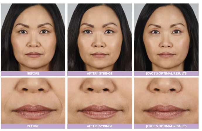 Кислота дермальных заполнителей увеличения губы Juvederm Ultra4 Hyaluronic