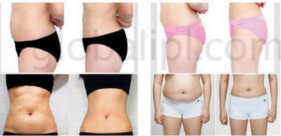 High Intensity Ultrasound HIFU Machine With Vacuum Cavitation System ISO13485