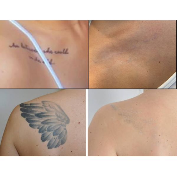 Машина для удаления татуировок Nd Yag Q Switched Laser Device