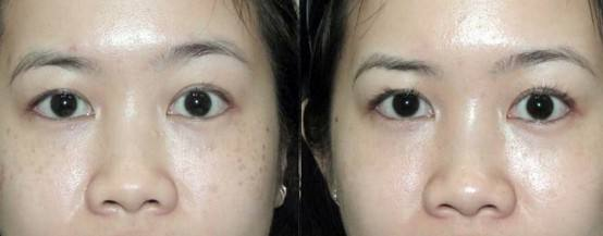 2018 most popular laser beauty machine tattoo studio used 532nm 1064nm PICOSECOND