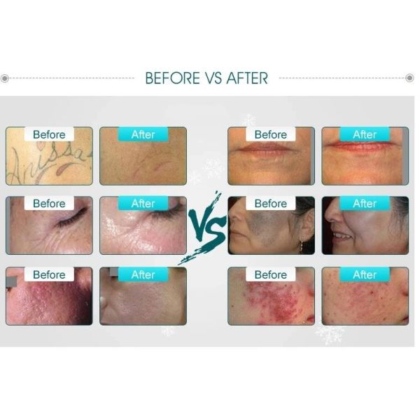 Picosecond Laser Machine For Tattoo Removal , Q Switch Laser Tattoo Removal Machine