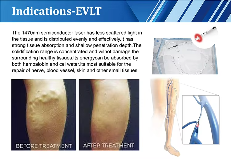 Leg Varicose Veins Laser Treatment EVLT  1940NM Diode Laser Machine
