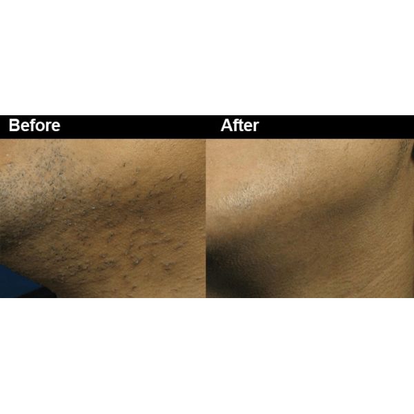 Long Pulsed 1064nm Nd Yag Laser Hair Removal Machine For Dark Skin Vertical Style