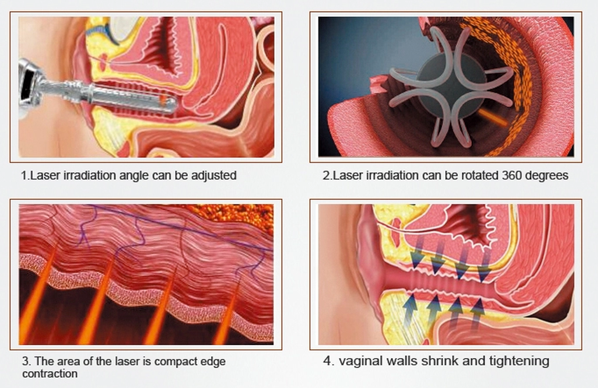 Dispositivo fraccionario del laser del CO2 médico para la piel del retiro de la cicatriz que vuelve a allanar el ajuste