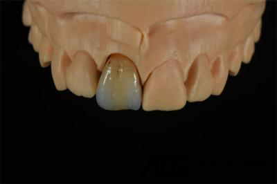 Dental Multi Layered Zirconia Crown Manufactured By China ADS Dental Lab