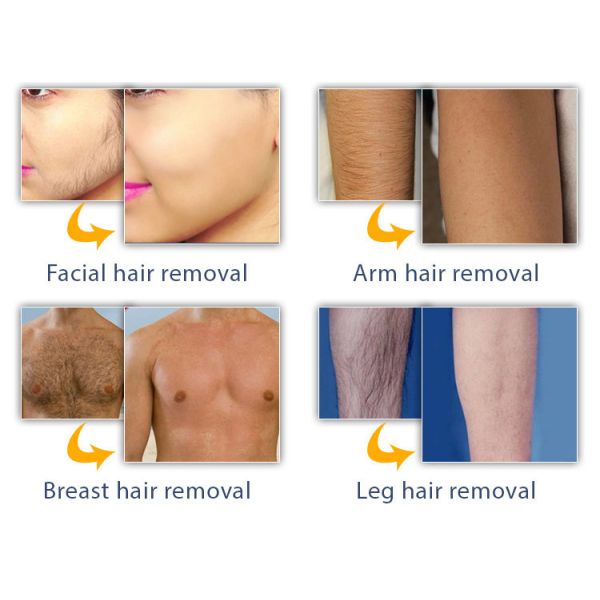 машина удаления волос лазера 2400W 590nm 430nm для клиники