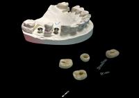 Parafusos para implantes dentários de superfície polida coroa retida para substituição dentária