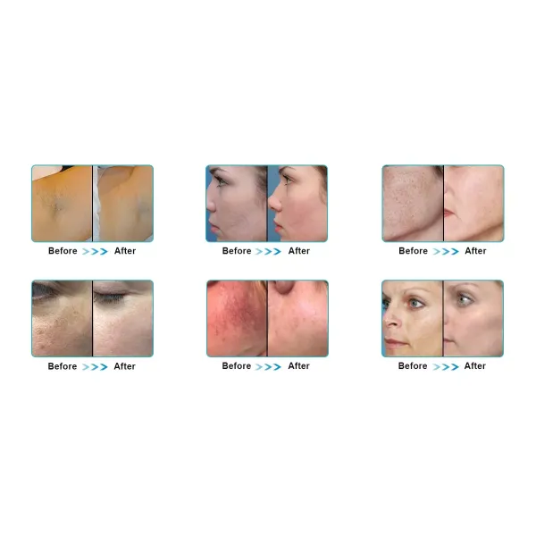 Эффективный тип 3 в 1 E-свете выбирает машина подмолаживания кожи Shr Ipl удаления волос лазера Shr Ipl