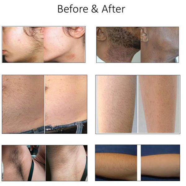 Germany Chips Non Channel 808nm Diode Hair Removal Laser Machine 900W