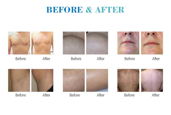 Professional ice soprano laser diode device hair removal triple wave medical laser on sale