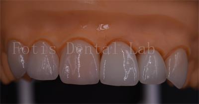 3 Shape Digital Crowns Good Compatibility Dentrues Design 1 Day Delivery