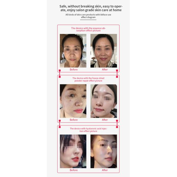 Face Target Area BBface Small Molecule Non-invasive No Needle Thread Lift EU Plugs Type