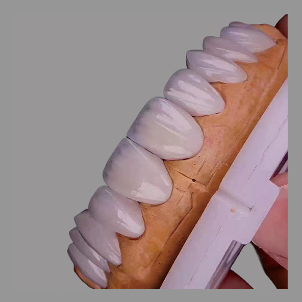 High Translucency IPS E Max Veneers Stains Resistant Biocompatible