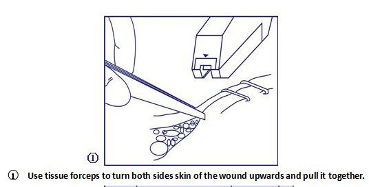 Medical Surgical Trupler Skin Stapler Machine With Scale And Remover