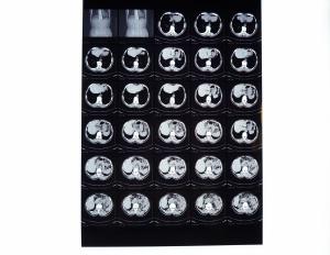 Filme seco de X Ray de Drypix 2000 8 x 10 polegadas Scrach resistente para Fuji