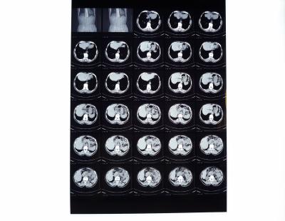 Filme high-density de X Ray de Digitas