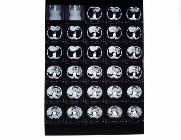 8in x 10in High Density Medical Dry Film For Fuji DRYPIX  3000 / 2000 / 1000 Printer