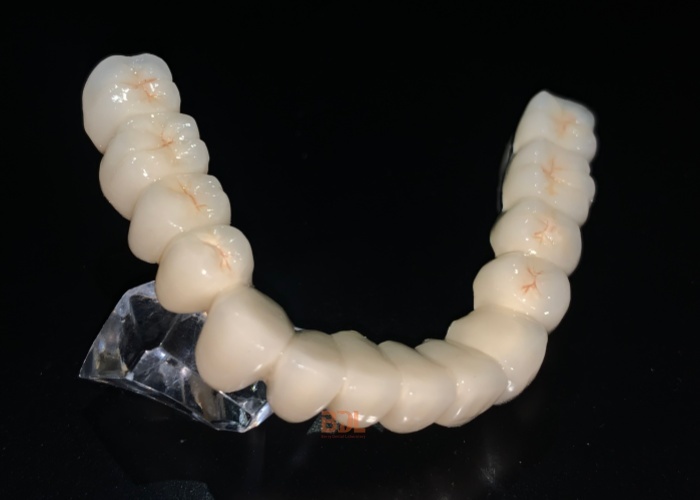 Custom Porcelain Fused To Metal Crown Designed To Provide Long Term Stability And Natural Look Ideal For Professional Dental