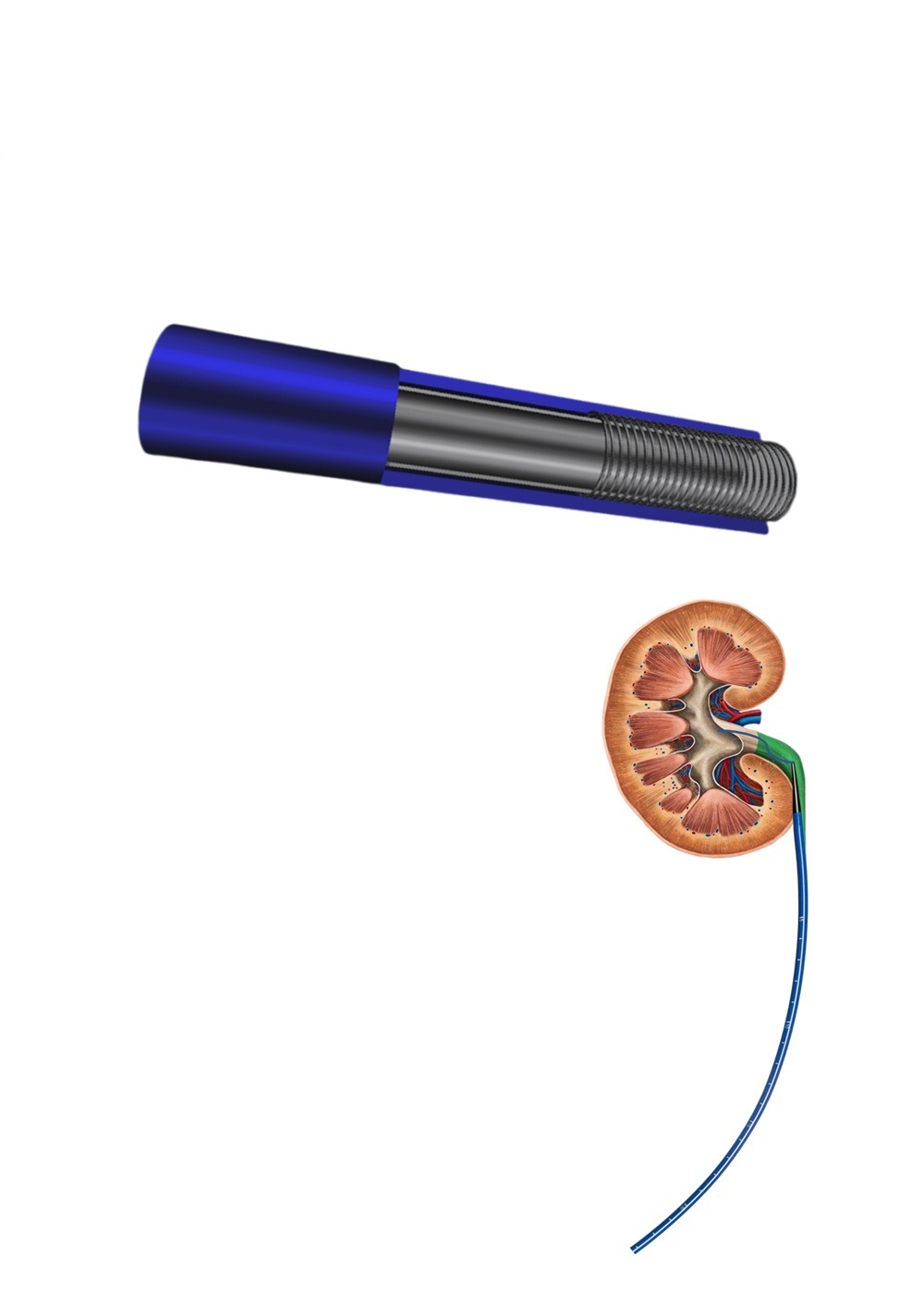 CE MDR Certification Smart Urethral Access Sheath Bluetooth Alerts 35cm Length With Pressure Monitoring