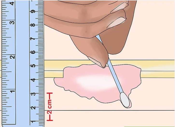Traitement des plaies auto-adhésif Ligne médicale réglateur de mesure pour infirmières Documentation