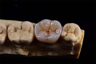 Layered Zirconia Crown for Natural Aesthetics from China Dental Lab