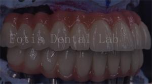 OEM Service Durable Dental Implant Temporary Crown Easy Maintenance