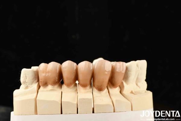 Bionic Development Leaves And Distinct Layers Of Zirconia All-Ceramic