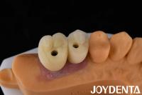 Implante de corona y puente de porcelana La solución definitiva para la restauración de los dientes perdidos
