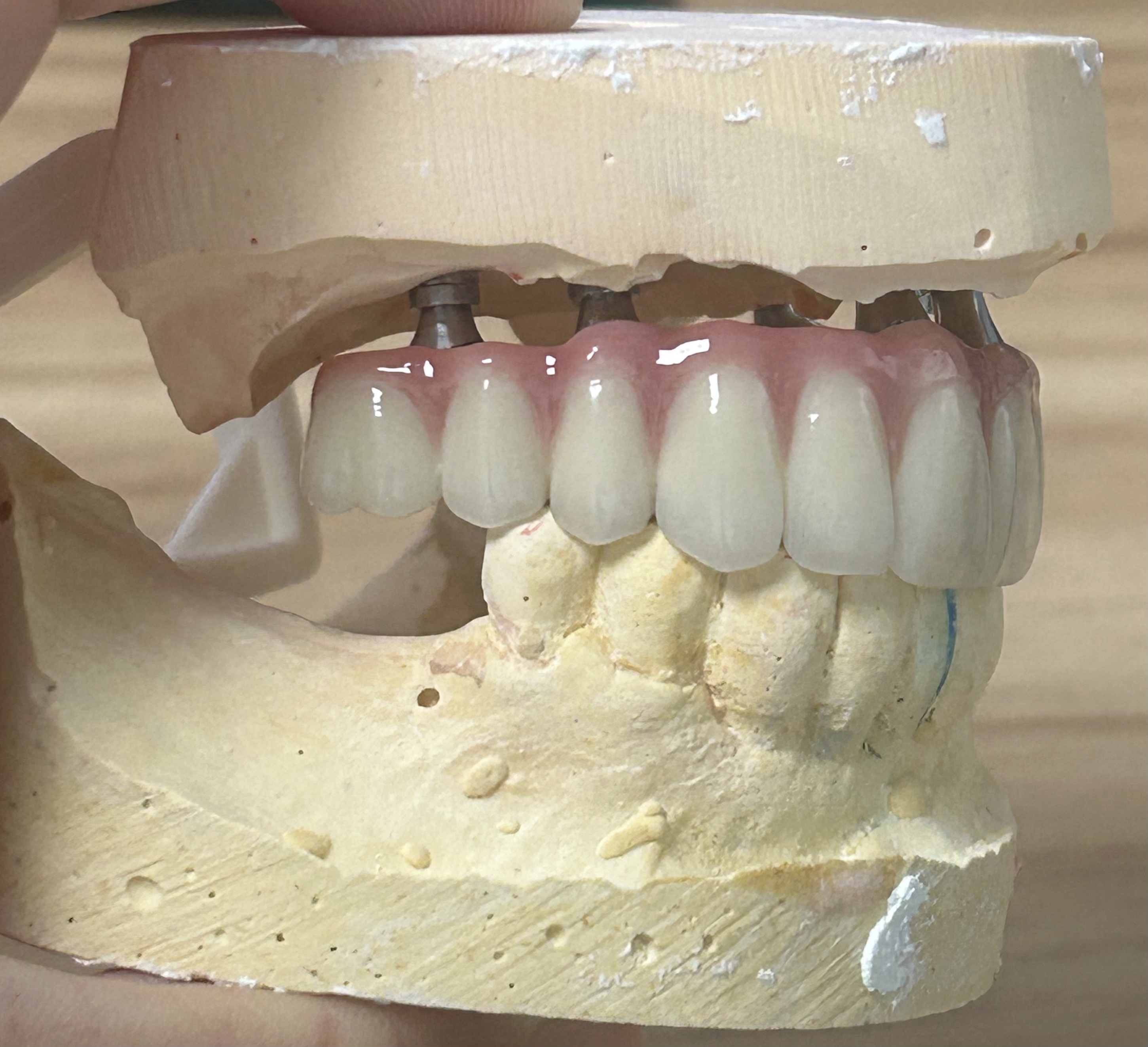 High-Strength Dental Zirconia Implant Crown with Natural Translucency & Tooth-Like Appearance via Digital CAD/CAM