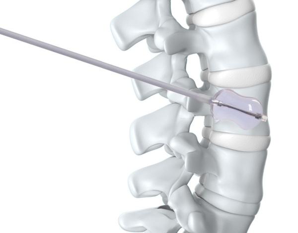 PKP Surgical Spine Kyphoplasty Instrument , Balloon Kyphoplasty Orthopedic Implants