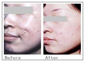 Warts Removal Fractional Co2 Laser Equipment Gray + White Color For Skin Tightening