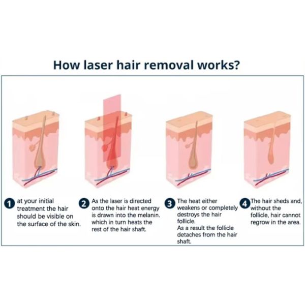 Desktop 808nm 810nm Diode Laser Machine Skin Whitening Body Hair Removal