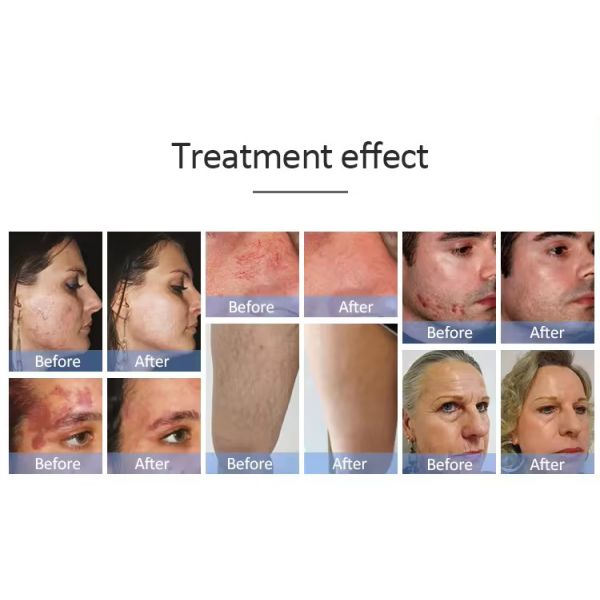 IPL OPT E-light Laser Hair Removal Permanent Machine 480nm 530nm 640nm