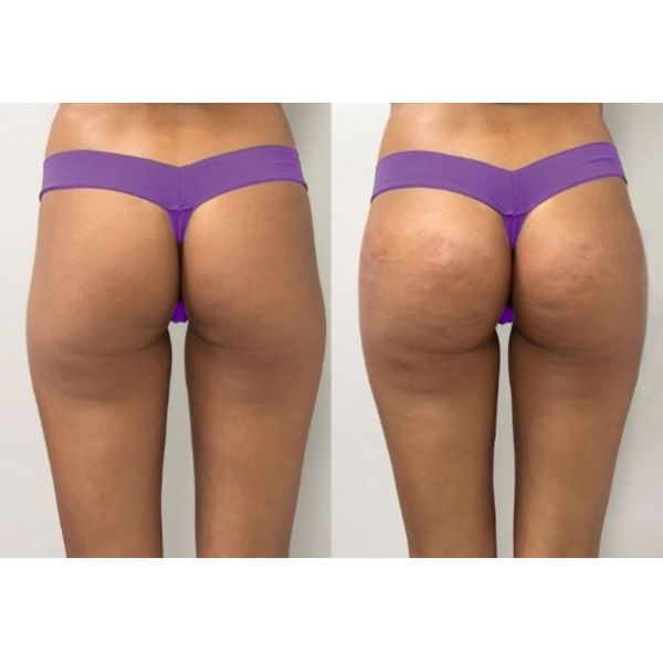Медицинская поли- Л- молочная кислота для лица Dermal Filler Dermal fillers 1 флакон X 5 ml