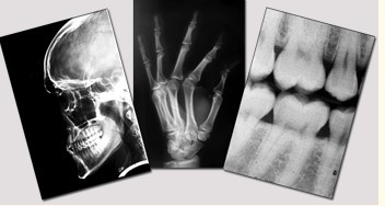 Blue Medical Dry Imaging Film , 11in x 14in Laser Fuji X Ray Film